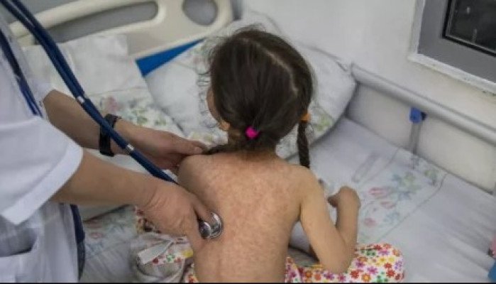 চট্টগ্রামে বাড়ছে হামের সংক্রমণ, নিউমোনিয়ায় আক্রান্ত শিশুদের সংখ্যা বেশি