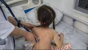 চট্টগ্রামে বাড়ছে হামের সংক্রমণ, নিউমোনিয়ায় আক্রান্ত শিশুদের সংখ্যা বেশি